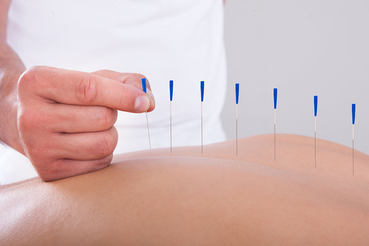 Acupuncture Palm Beach