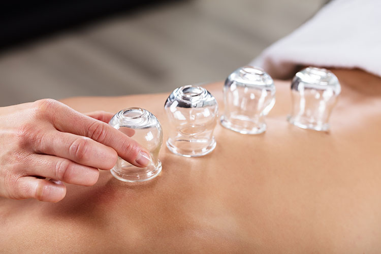 Cupping Therapy Miami