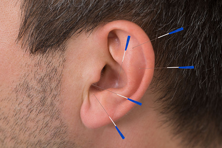 Acupuncture Miami